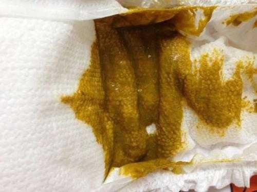新生儿正常的大便是啥样的