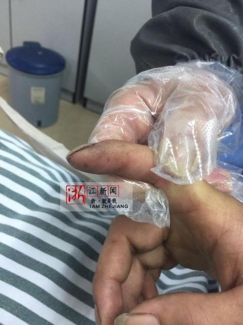 急救宝宝被宠物咬伤