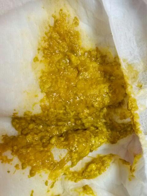 宝宝消化不好的原因有哪些