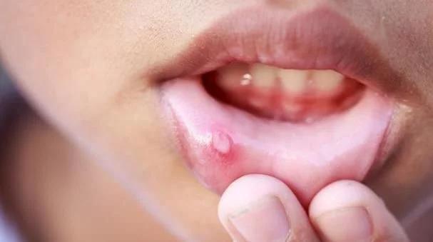 口腔溃疡有多难受