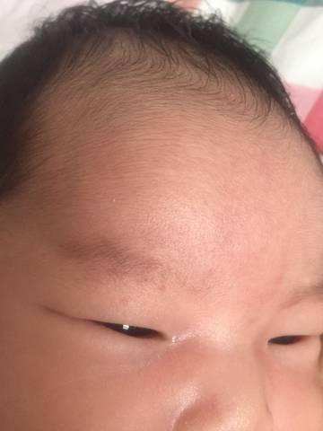 宝宝长湿疹怎么办