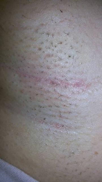 脱毛膏和脱毛仪哪个效果好一点