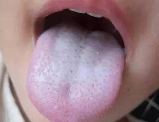 孩子生病咳嗽怎么办
