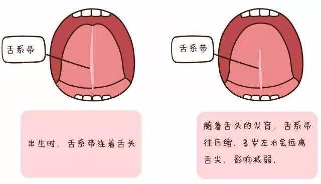 舌系带过短到底要不要剪