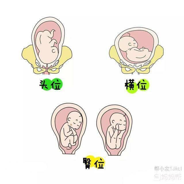 胎儿头位和臀位哪个好