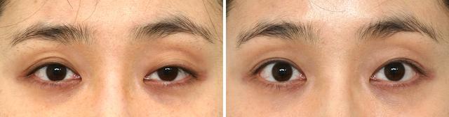 哺乳期出现大小奶怎么纠正