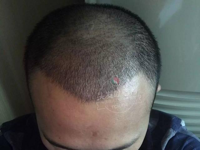 雄性激素多的特征