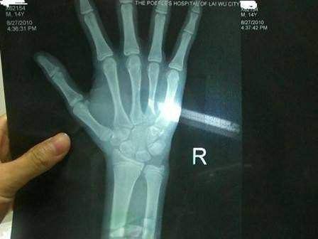 12岁孩子骨龄偏大怎么办