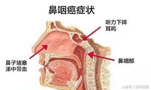 分泌性中耳炎的症状有哪些