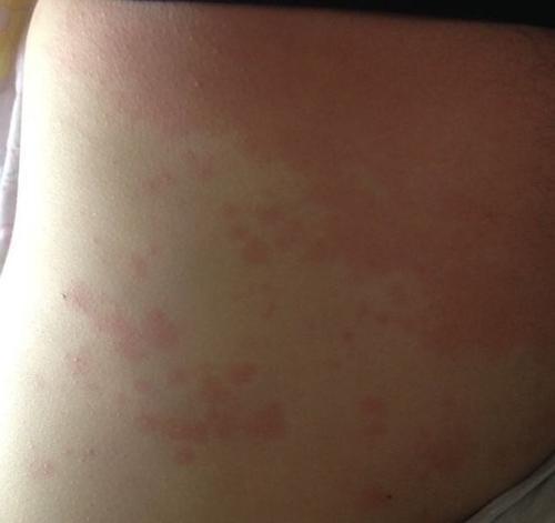 孩子痒得很不用药可以怎么治