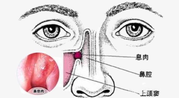 宝宝鼻息肉是什么原因引起的
