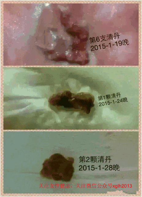 宫颈息肉不治疗自己会好吗