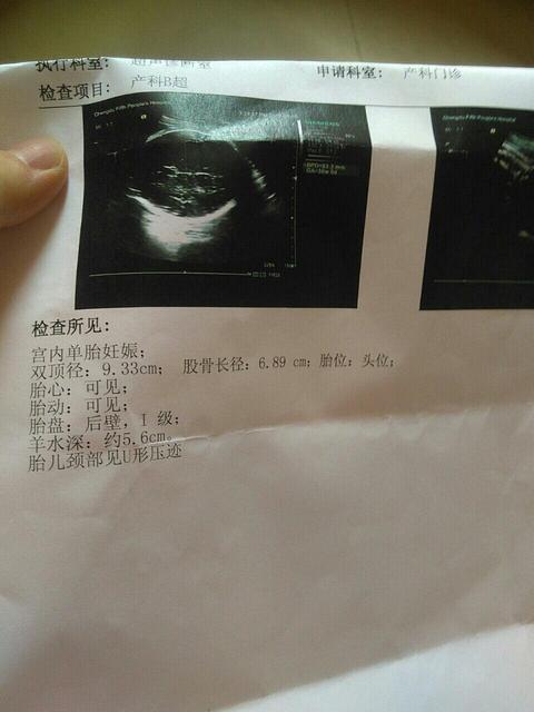 彩超怎么显示胎儿入盆