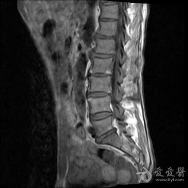 男性生活过后腰痛是怎么回事