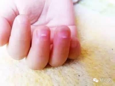 怎么知道孩子身体有虫