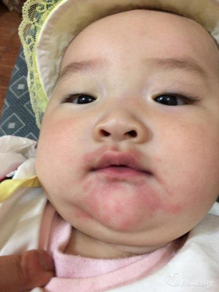 宝宝奶粉过敏的症状及治疗方法