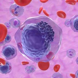 一类造血干细胞恶性克隆性疾病