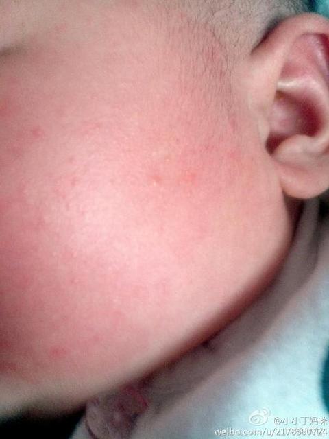 治疗痱子最快最有效的办法是什么