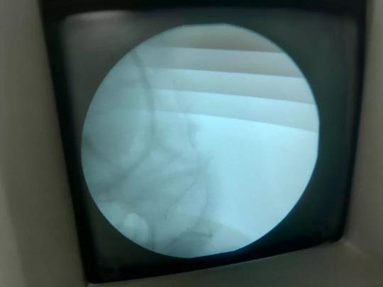 科技正文在x线监视下,经肛门插入电子结肠镜,从活检孔中插入超长超
