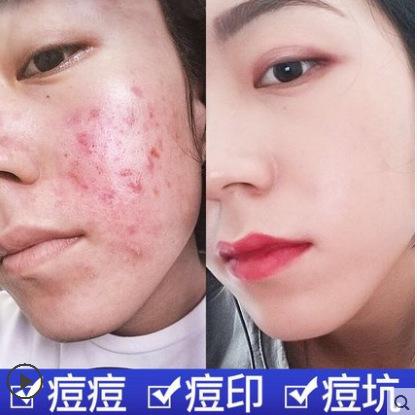 疤复平祛痘印痘疤痘坑修复精华霜妊娠纹淡化肥胖纹抖音去豆神器巴