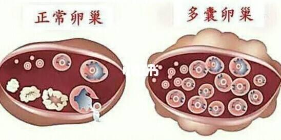 多囊卵巢综合症怀孕初期要注意什么