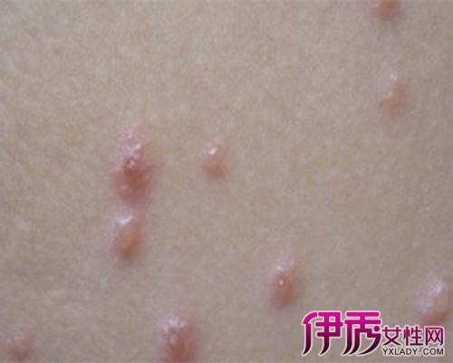 宝宝出水痘会传染给妈妈吗