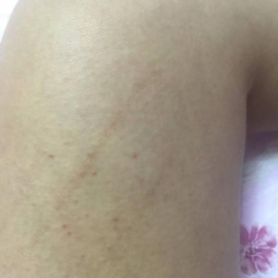 宝宝身上的红印子是什么东西