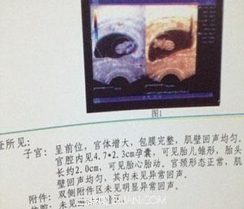 孕妇上腹部发硬发紧是怎么回事