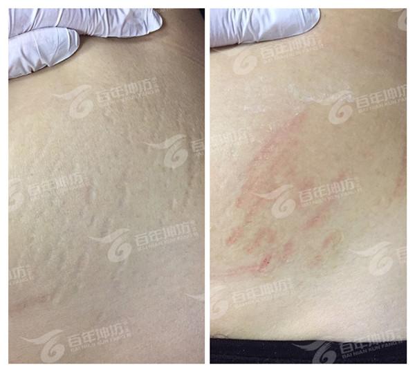妊娠纹能看出来是男是女么
