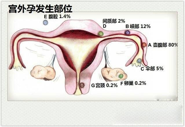 如何治疗宫外孕如何治疗宫外孕最佳