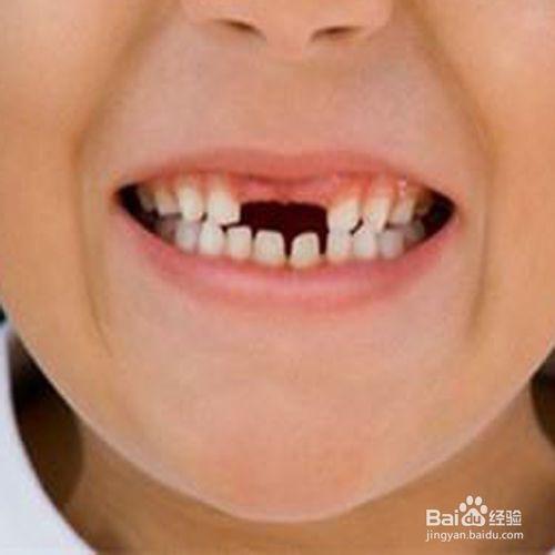 儿童几岁开始换牙正常