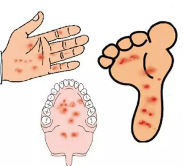 手足口和水痘的区别图图片