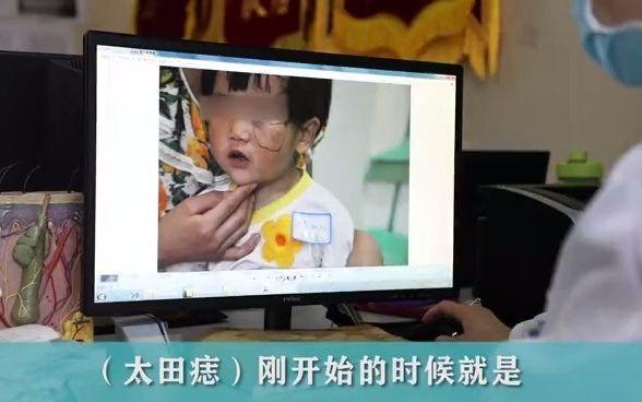 孩子胎记如何形成的