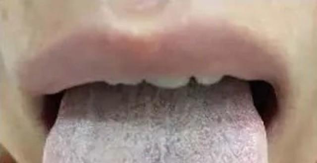 多囊患者怎么治疗才能恢复排卵