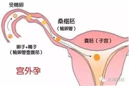 早孕期阴道出血是怎么回事