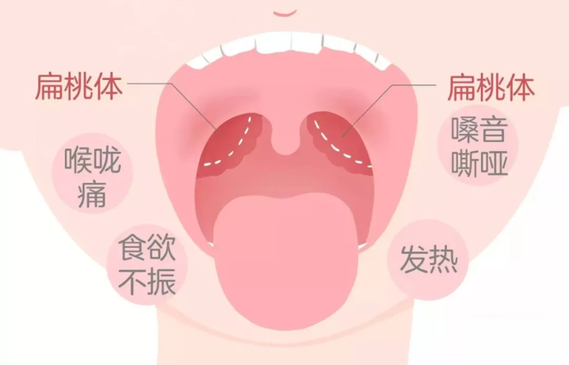 孩子扁桃体发烧怎么办