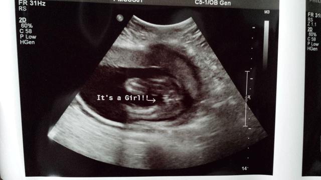 通过妊娠线就能知道宝宝性别 通过妊娠线就能知道宝宝性别