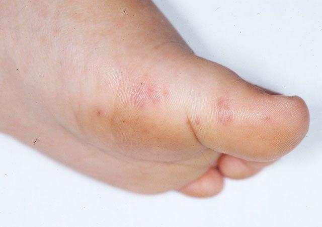 手足口病口腔溃疡几天会好