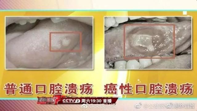 口腔溃疡发朋友圈的说说