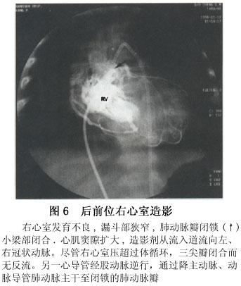 胎儿三尖瓣少量反流要注意什么