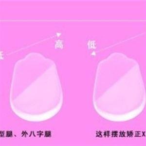 宝宝腿不直是o型腿吗
