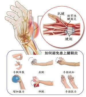 手指腱鞘炎的症状有哪些