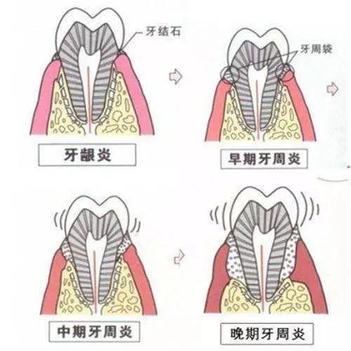如果出现裂纹很深,就会出现类似于牙髓炎或根尖周炎的症状,需要根管