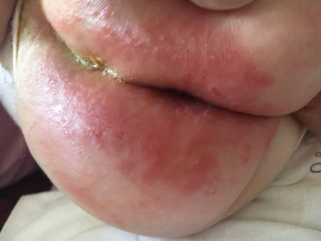 想要娃远离红屁屁