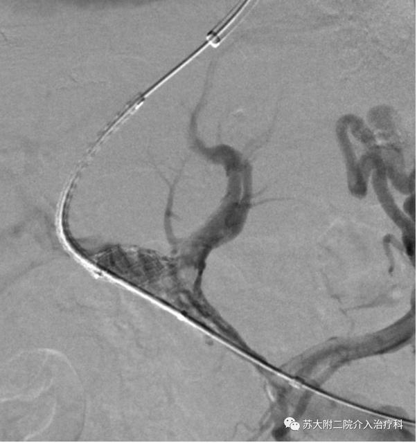 冠状病毒在温度较高的夏天比较不活跃