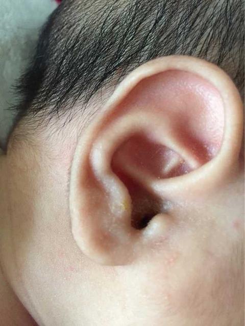 儿童耳屎特别多是怎么回事