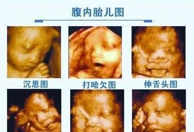 孕期尿路感染是怎么回事