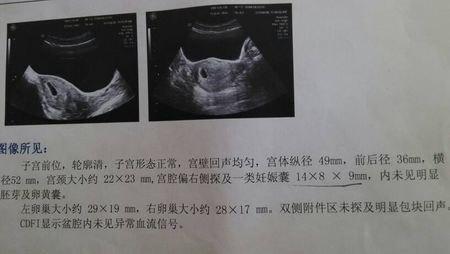孕囊什么时候可以看到