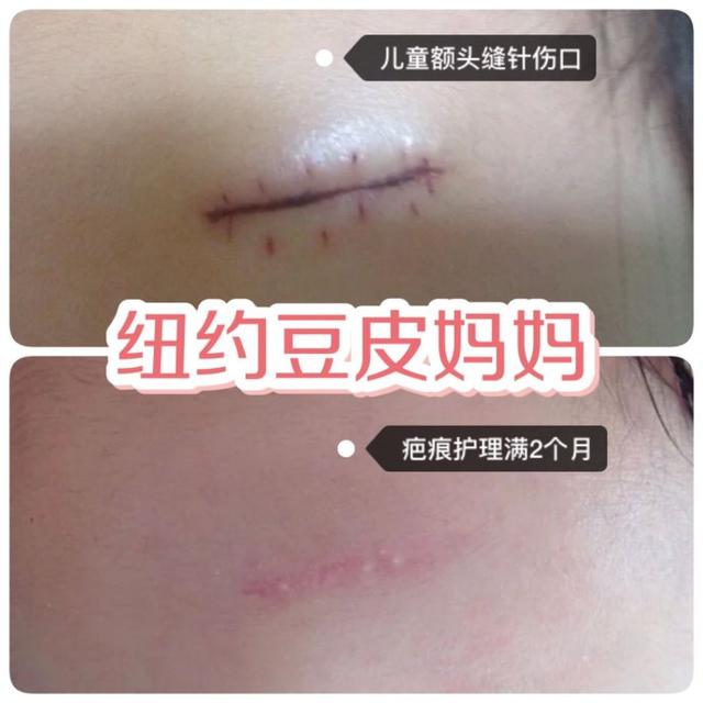 剖宫产竖切口怎么护理