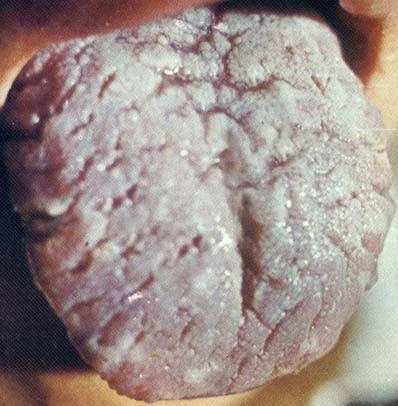 宝宝地图舌有什么症状